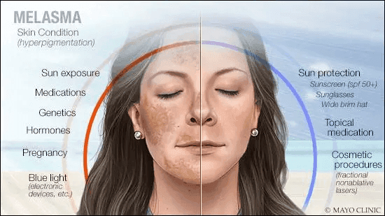 Hyperpigmentation from sun damage